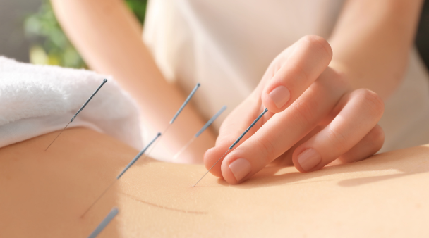 Acupunctura Ombilicala: Metoda Moderna Inspirata din Intelepciunea Straveche