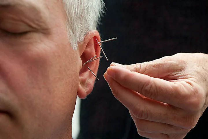 Acupunctura auriculara Bucuresti – Auriculoterapie la Hong Long Clinic pentru dureri, stres si dependente