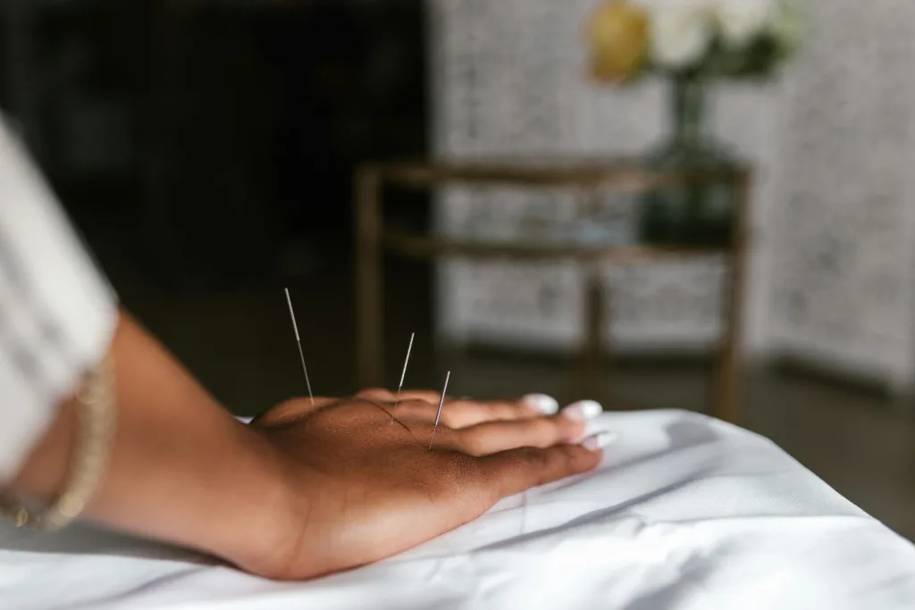 Close-up of acupuncture needles in a hand during treatment, promoting relaxation.