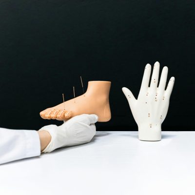 acupunctura medicala spitale china